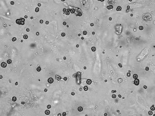 Harnsediment - Auswahlbild 1