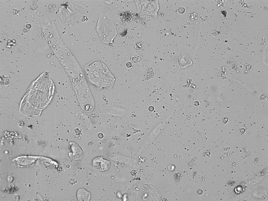 Harnsediment - Auswahlbild 2