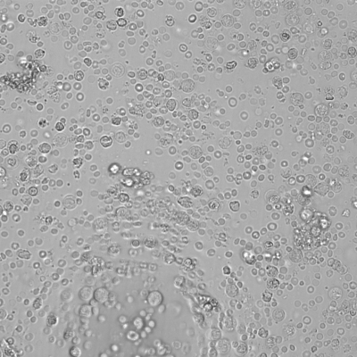 Nephrtitisches Sediment