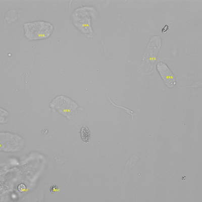 Hyaline Zylinder