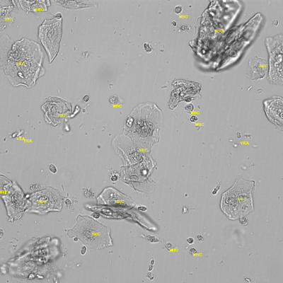 Leukozyten und Plattenepithelien